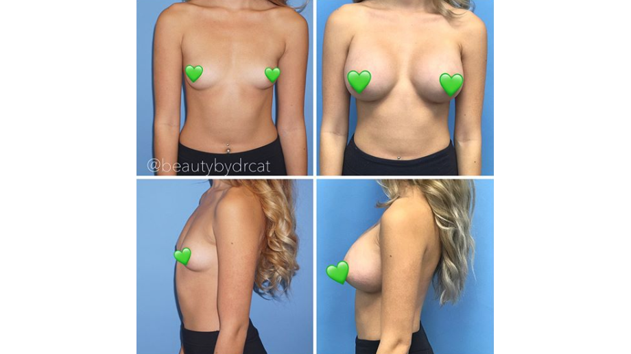 Breast Perkiness Guide  Dr. Cat Plastic Surgery
