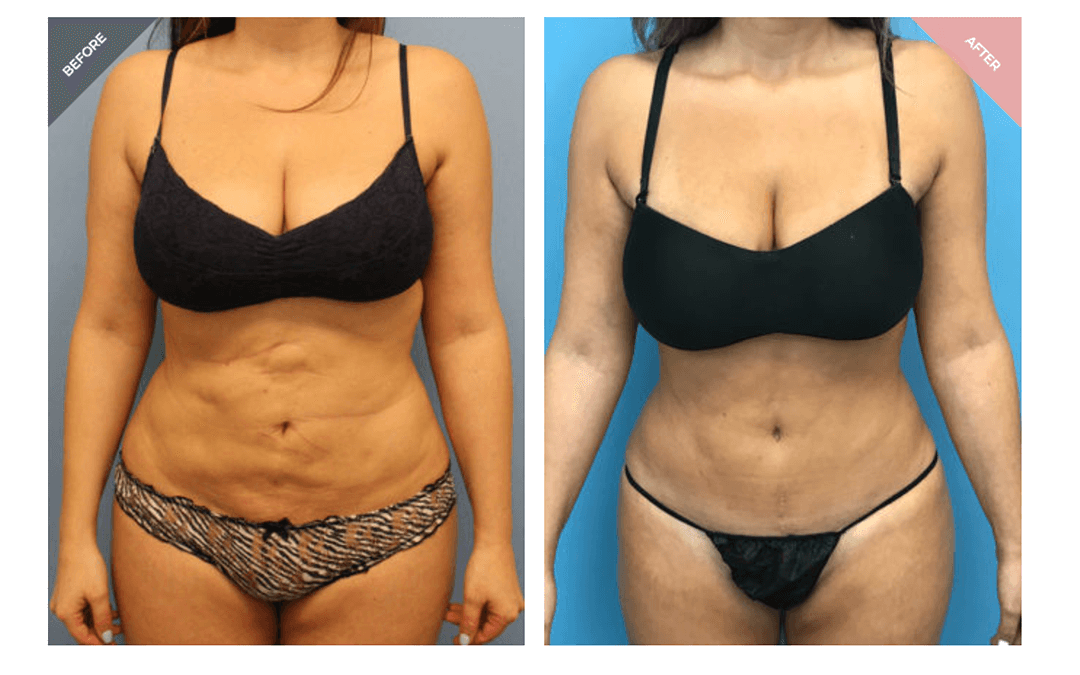 Tummy Tuck Revision and Repair by Beverly Hills Female Plastic