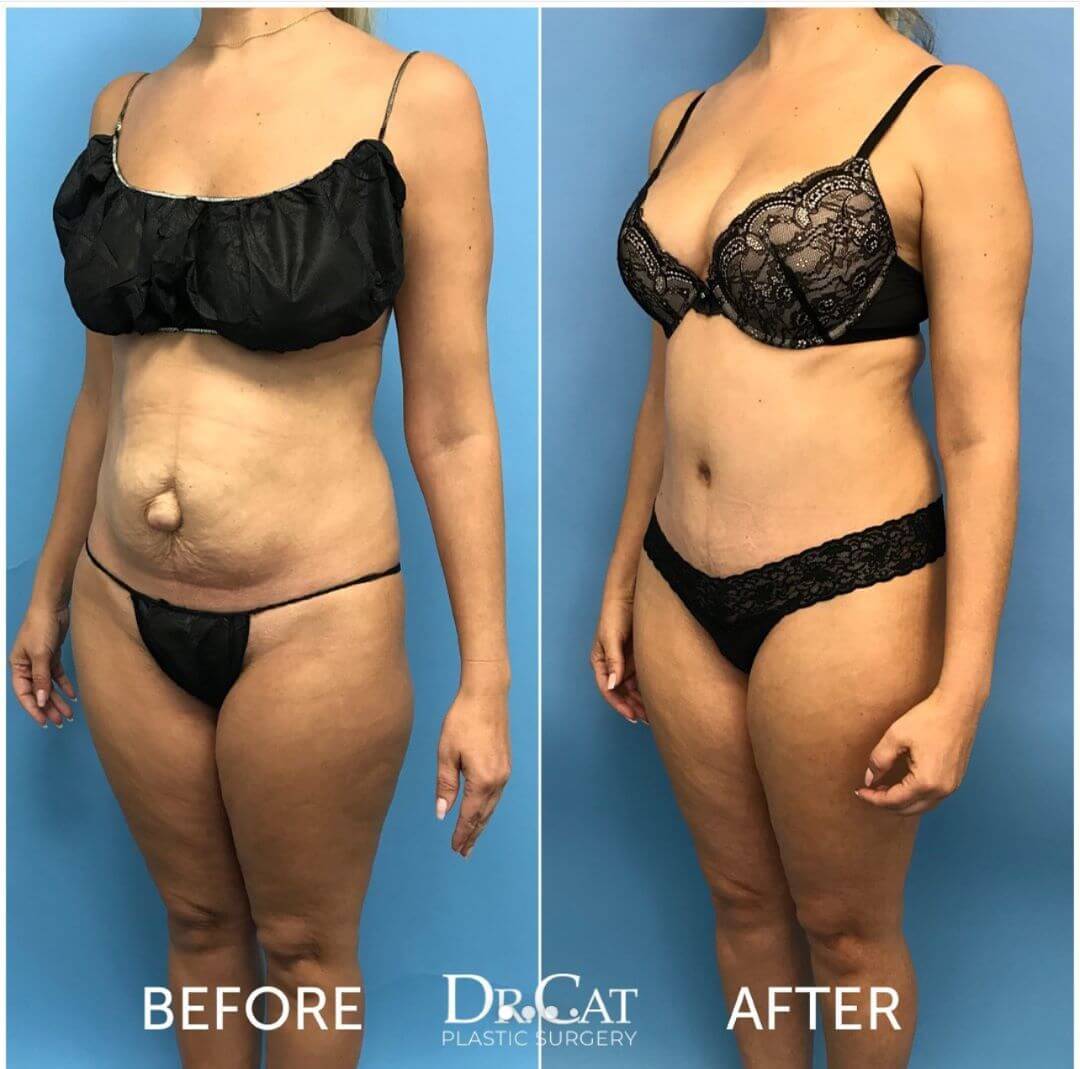 Tummy tuck before and after by Dr. Cat, three-quarter view: loose skin folding over the lower abdomen before, a flat and tight abdomen with the scar hidden under underwear after