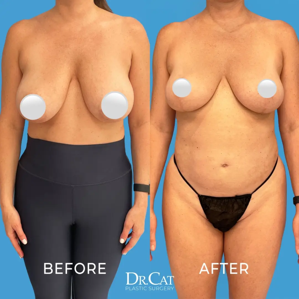 Breast Reduction Nipple Sensation | Dr. Cat Plastic Surgery