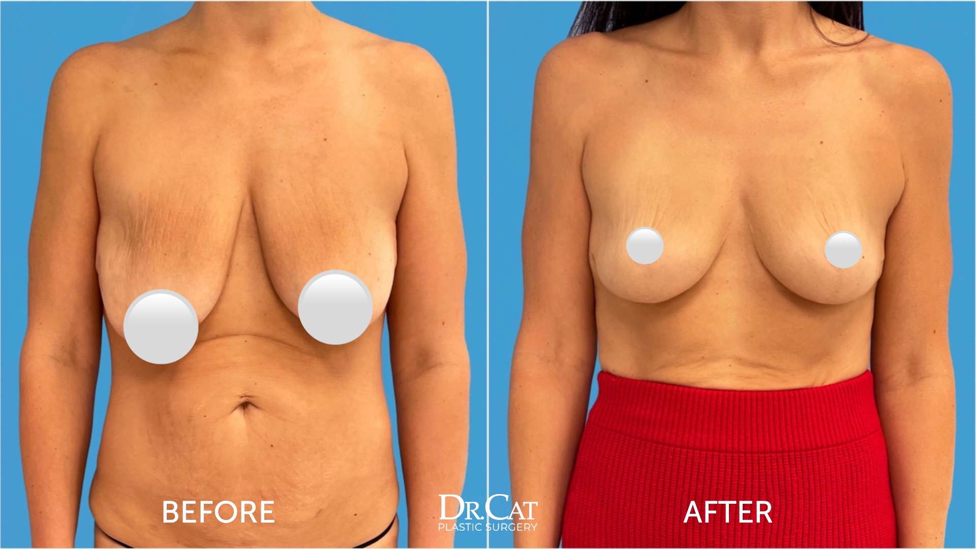 Is Breast Reduction Surgery Right for Me?