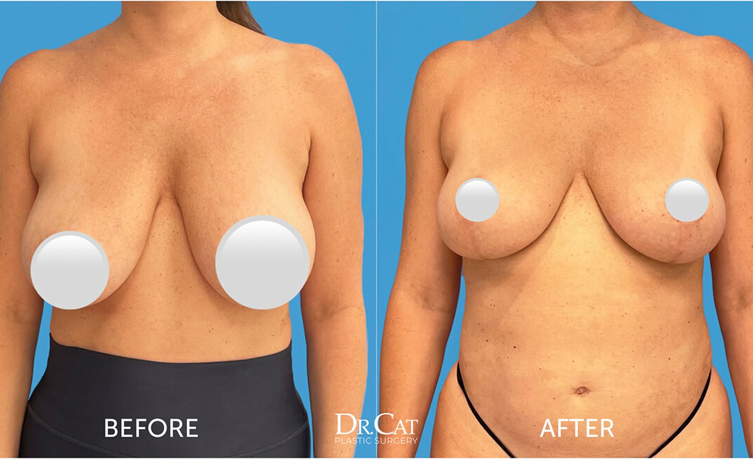 How Breast Lift and Breast Reduction Can Help Large Breasts