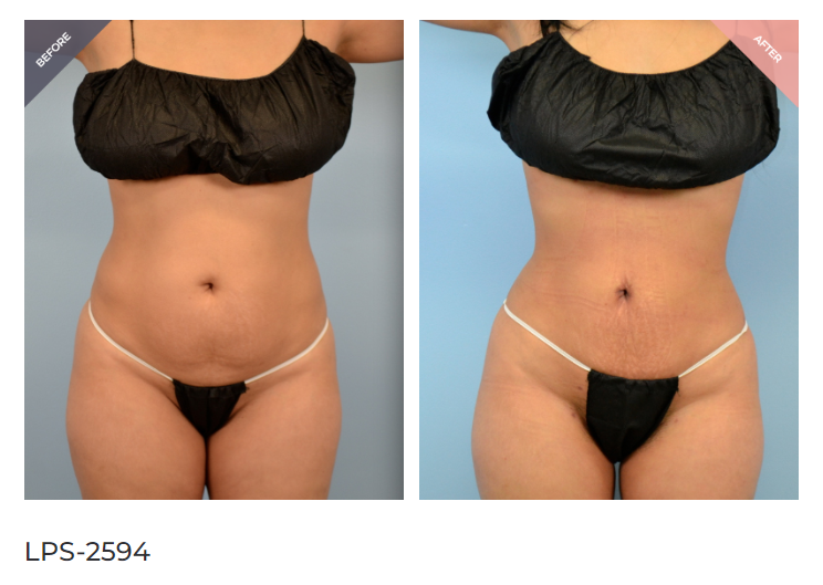 Lower Stomach AirSculpt®  Forget Tummy Tucks and Liposuction