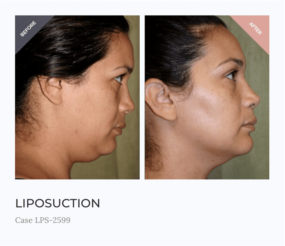 chin liposuction 