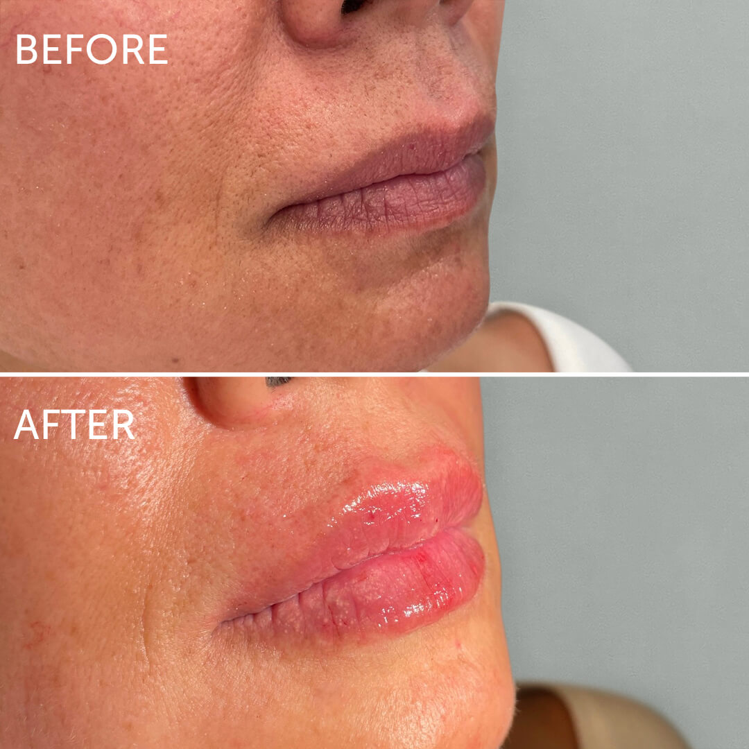 Lip Filler Swelling Stages A Week By Week Guide Dr Cat Begovic