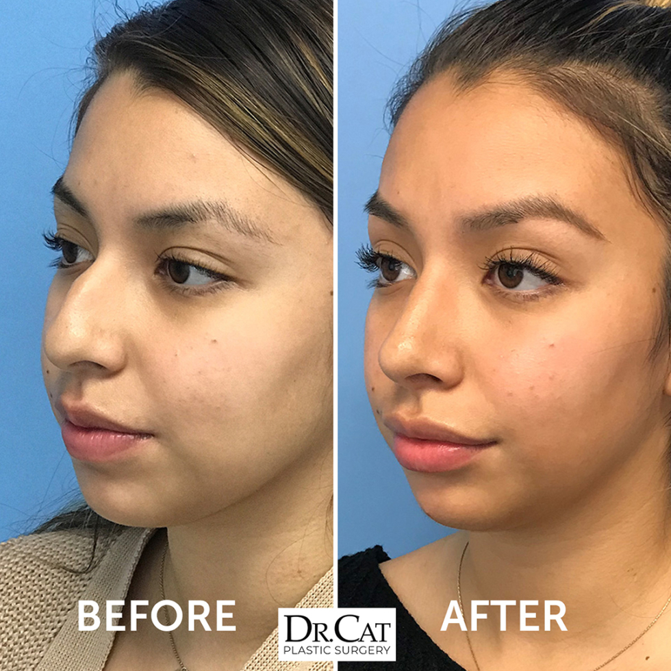 Open vs. Closed Rhinoplasty | Dr. Cat Plastic Surgery