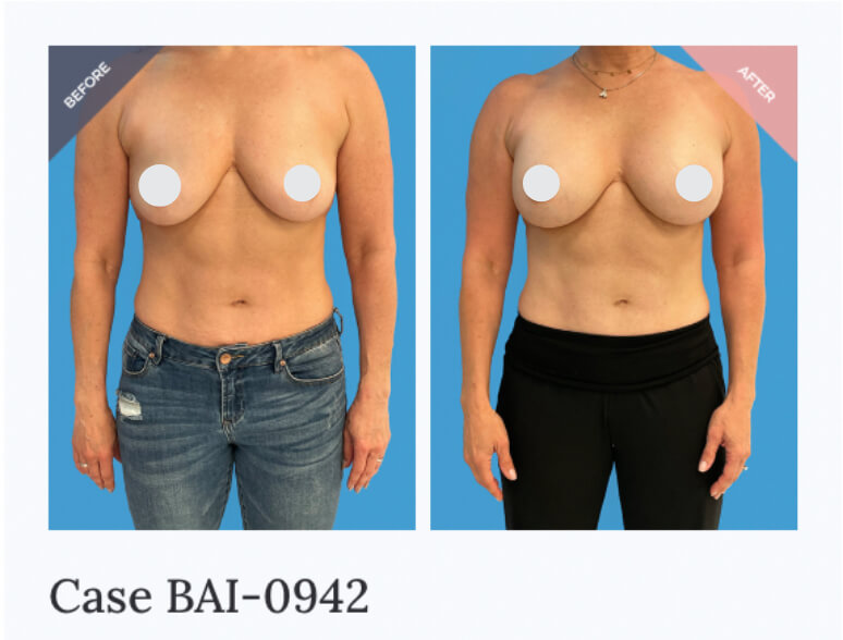 Breast Augmentation Scar Treatment: Tips for Healing