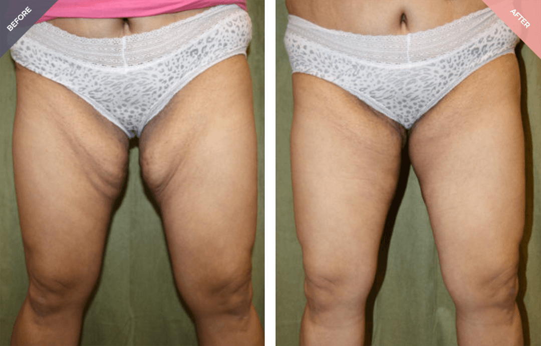Thigh lift recovery aftercare supporting optimal scar healing at Dr. Cat Beverly Hills