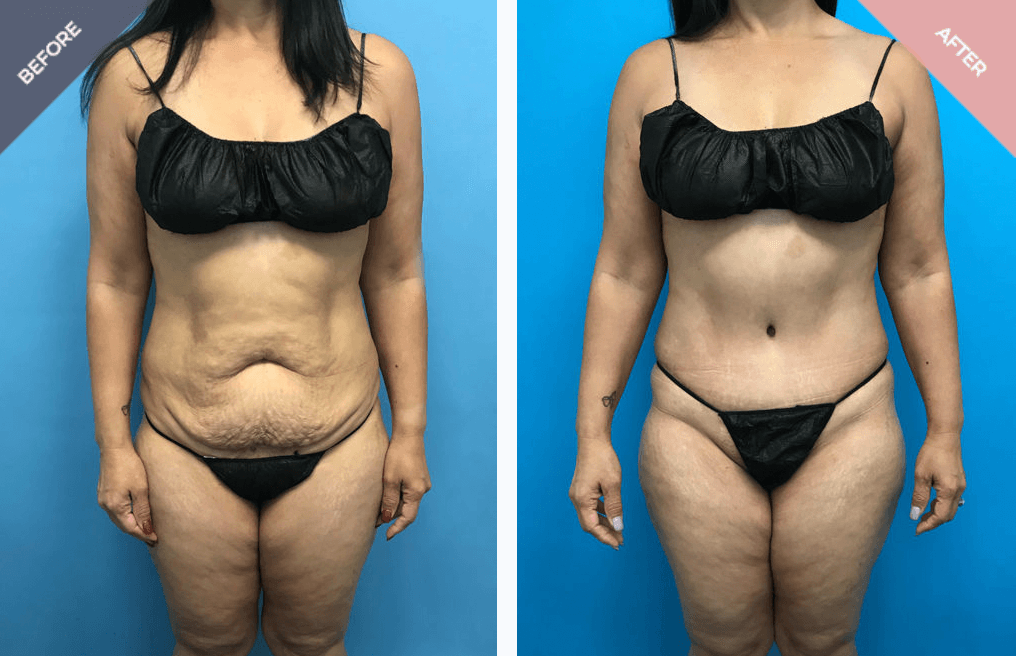 Tummy tuck with muscle repair surgical technique, abdominal muscle tightening