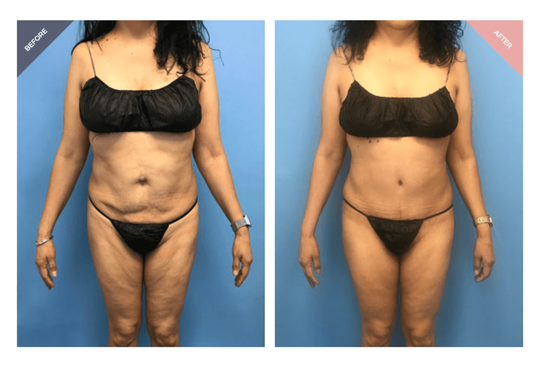 Before and after tummy tuck revision correcting botched results by Dr. Cat Beverly Hills