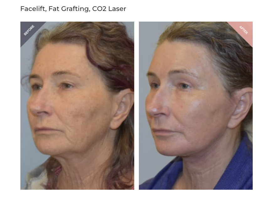 Facelift before and after 