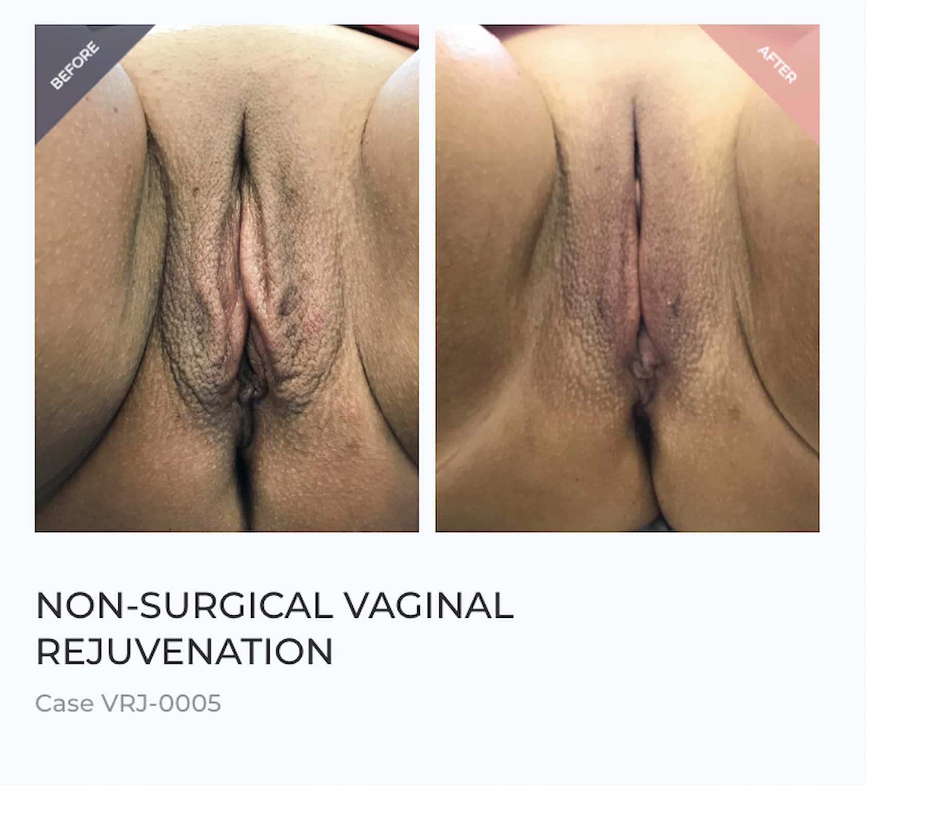 Vaginal Rejuvenation Before and After