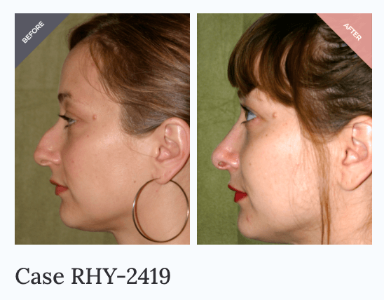 Rhinoplasty case study before and after