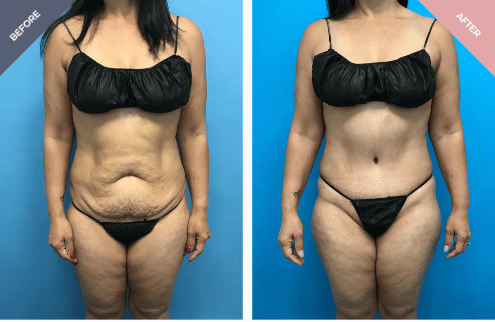Reverse Tummy Tuck, Upper Abdominoplasty