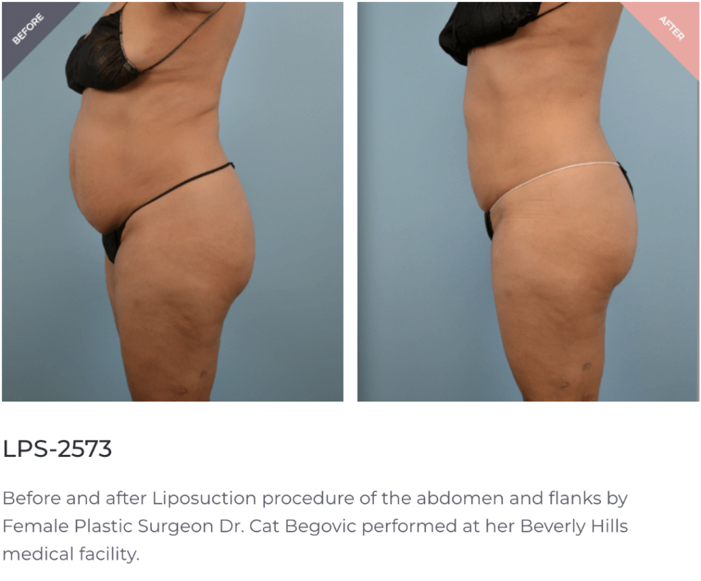 Why Compression Garments are important after Liposuction? In the first 2-3  weeks of healing, it is recommended for most patients to wear…