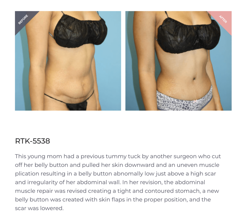 Is Tummy Tuck Surgery Painful? A Comprehensive Insight