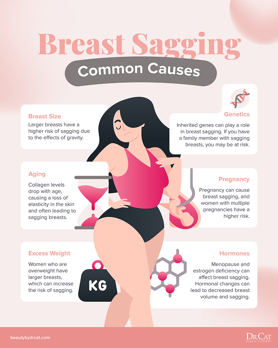 Breast surgery patient result for saggy boobs Beverly Hills