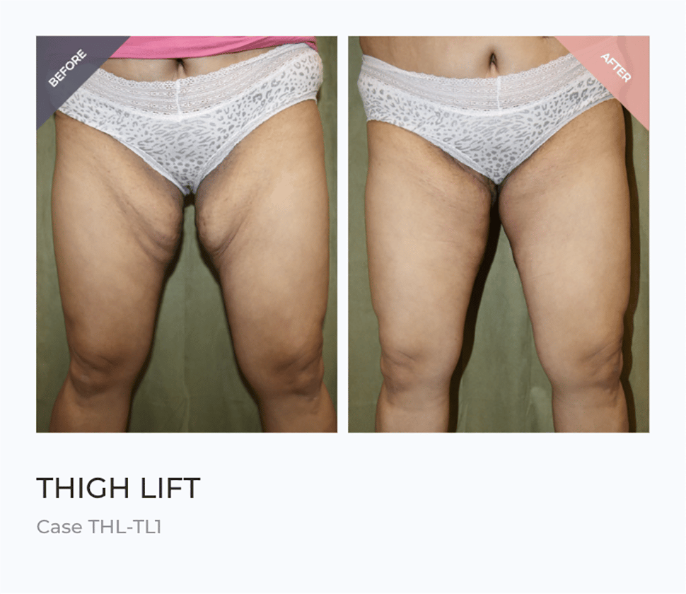 Thigh lift surgery types and patient results at Dr. Cat Beverly Hills