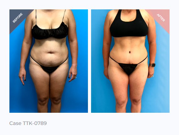 Tummy Tuck Beverly Hills Results Before and After 