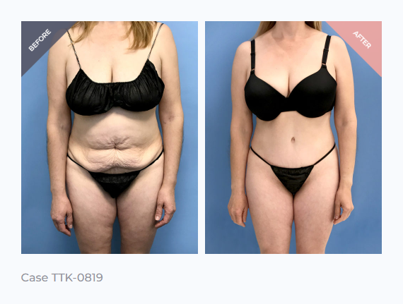 Tummy Tuck Surgery Beverly Hills Before and After 