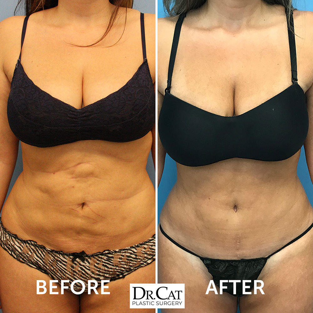 Botched Liposuction Repaired Before and After Revision Surgery