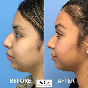 beverly hills rhinoplasty before after