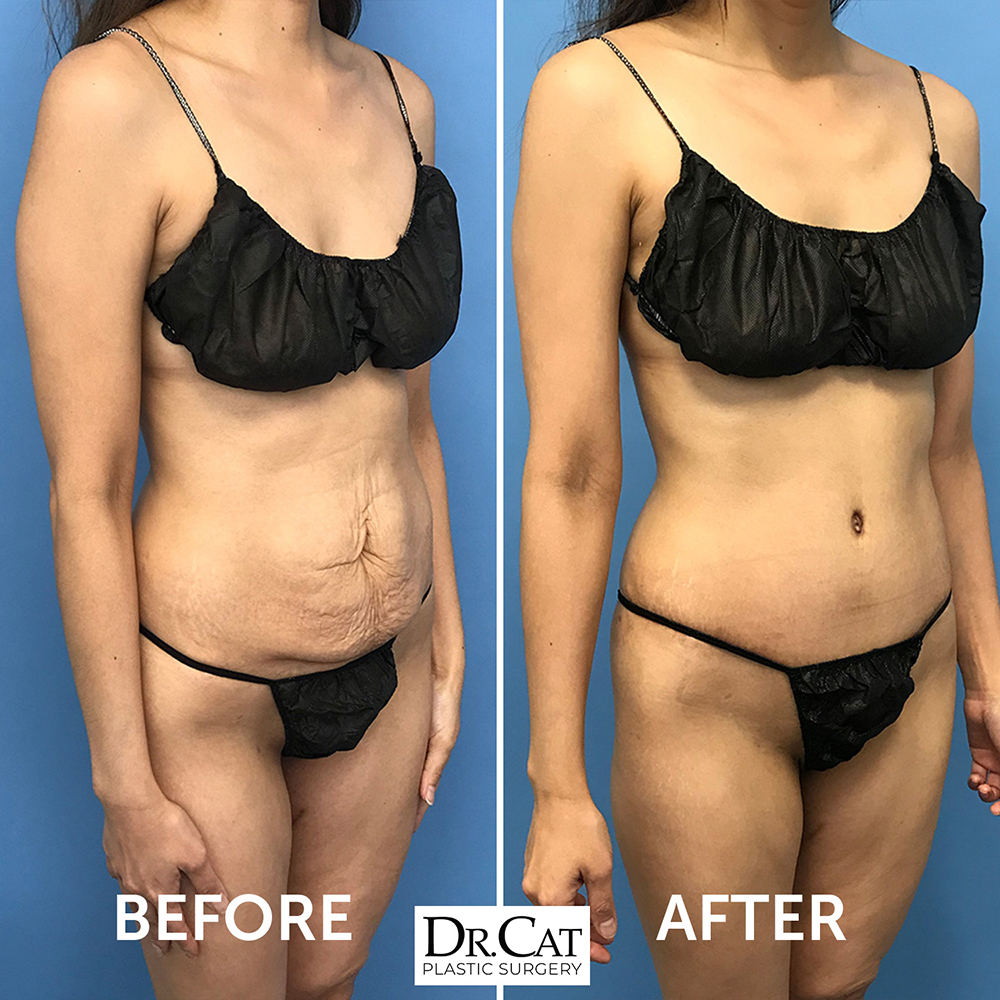 Loose Skin Surgical Fix