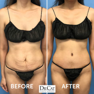 mini tummy tuck before and after photo