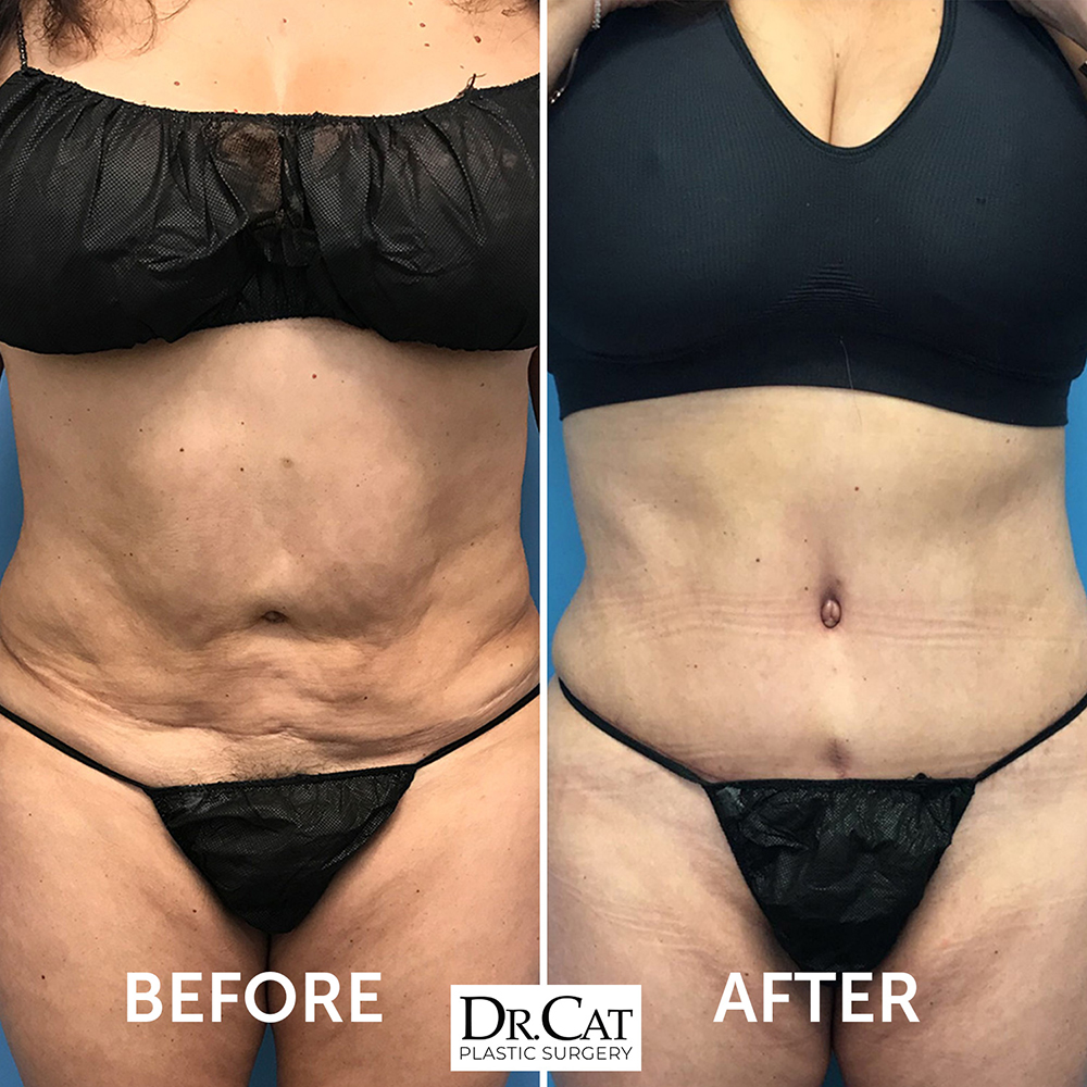 Bad liposuction gone wrong fixed with corrective surgery, before and after results