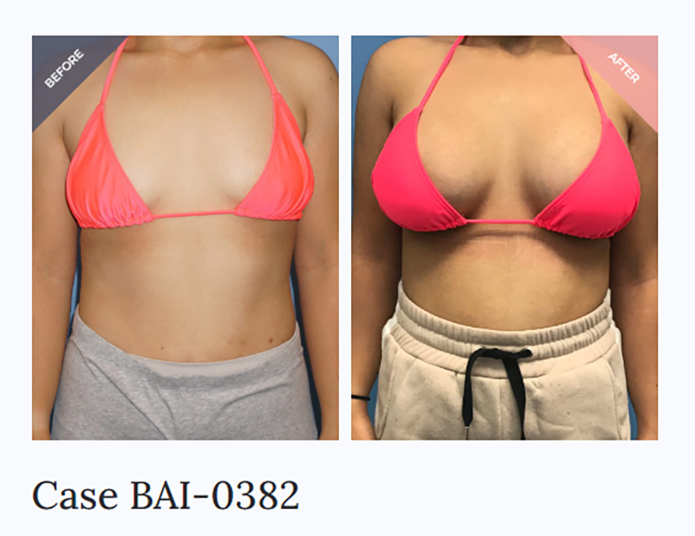 Breast augmentation results