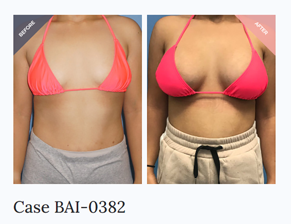 Breast Augmentation Austin