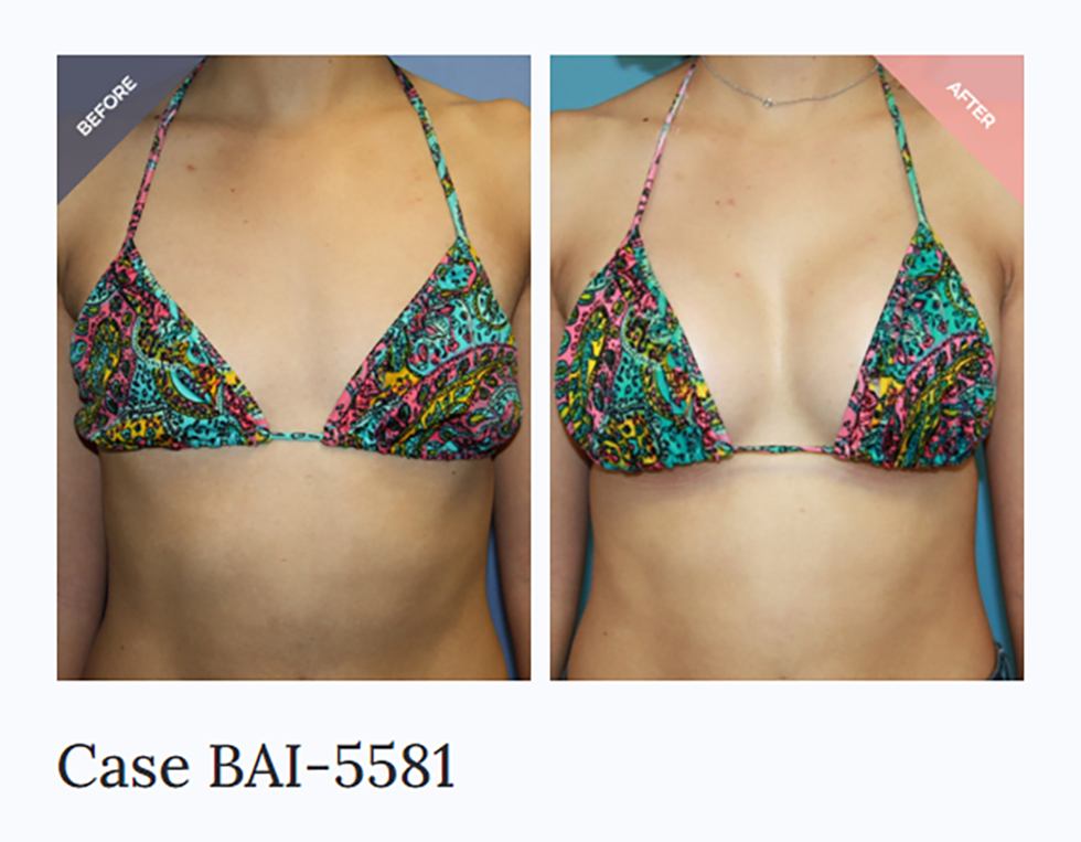 How To Maintain Your Breast Augmentation Results