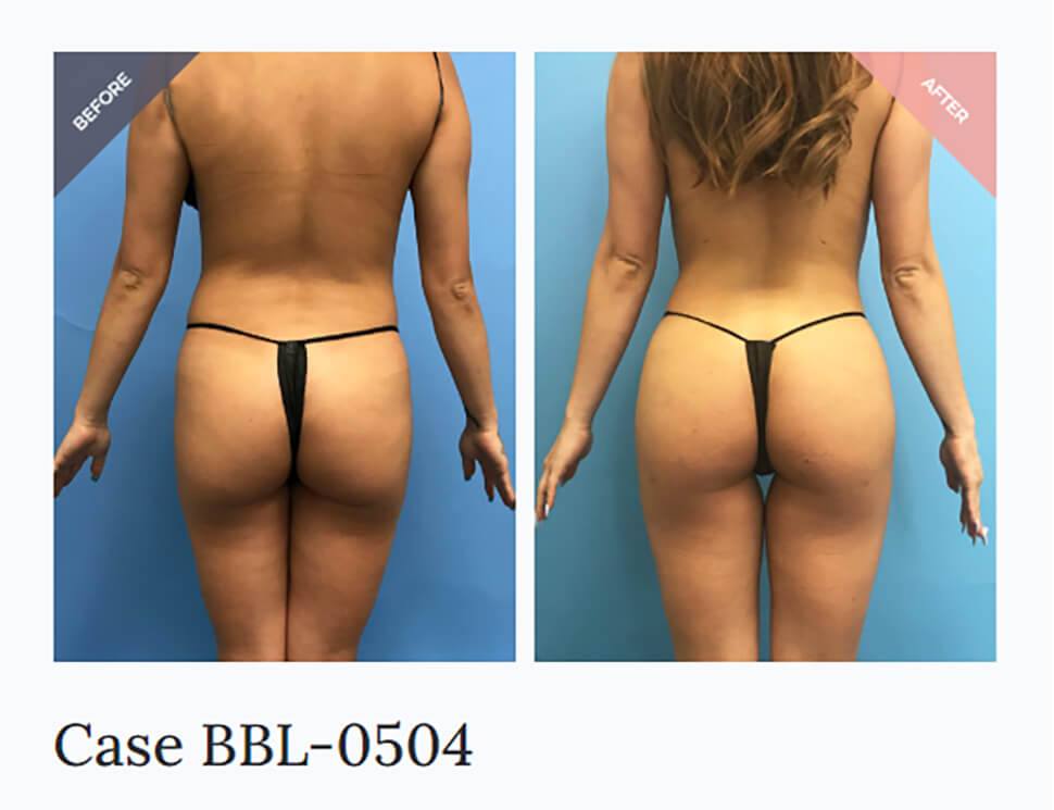 BBL before and after