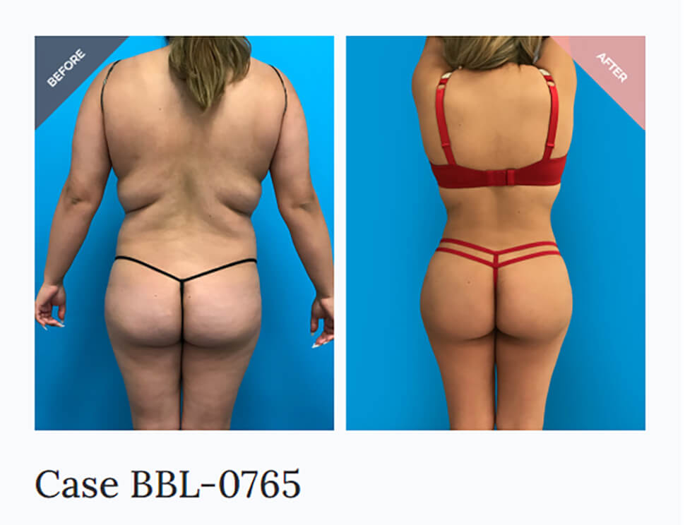 Brazilian Butt Lift: What to Expect on the Day of Surgery