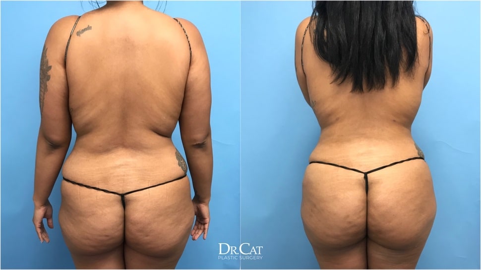 Post Partum Body Shaping & Contouring