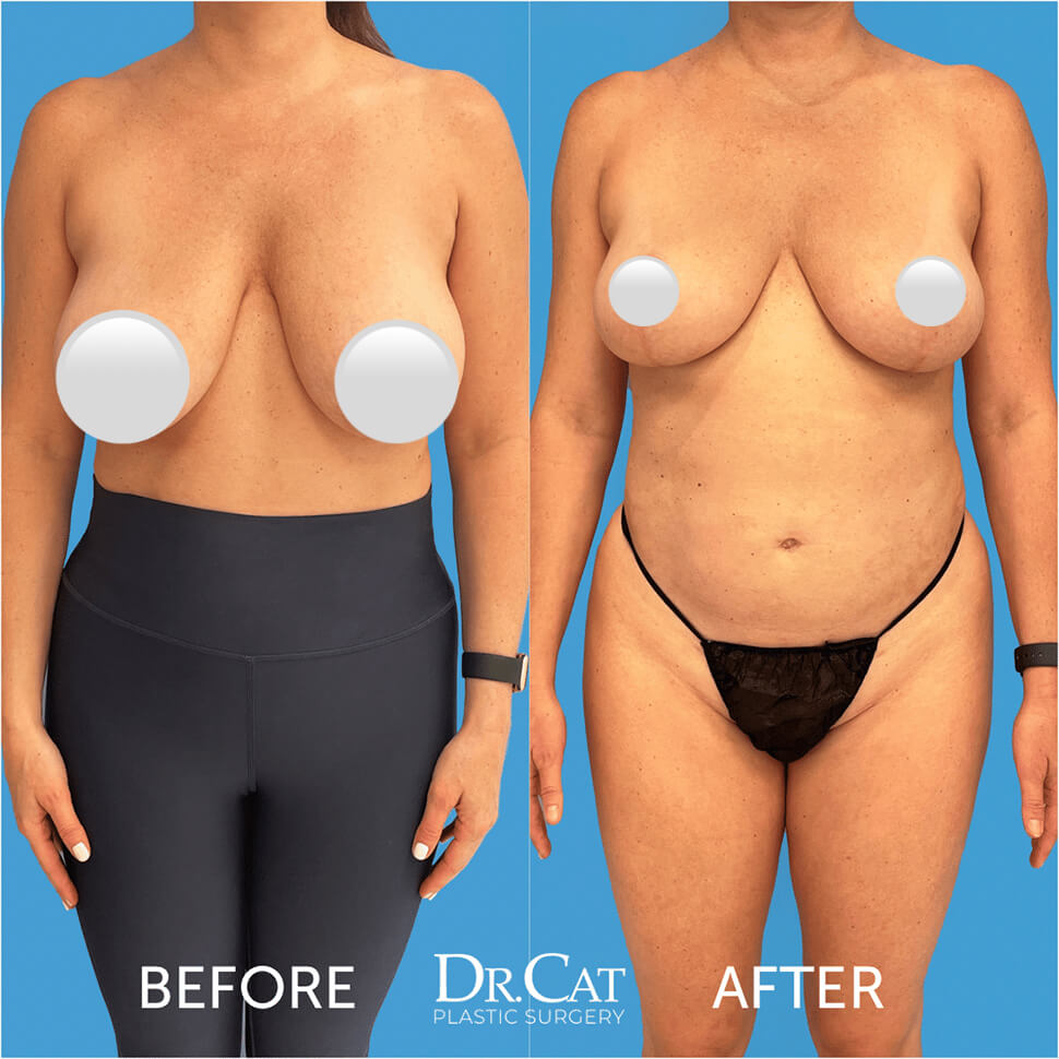 Benefits of breast reduction