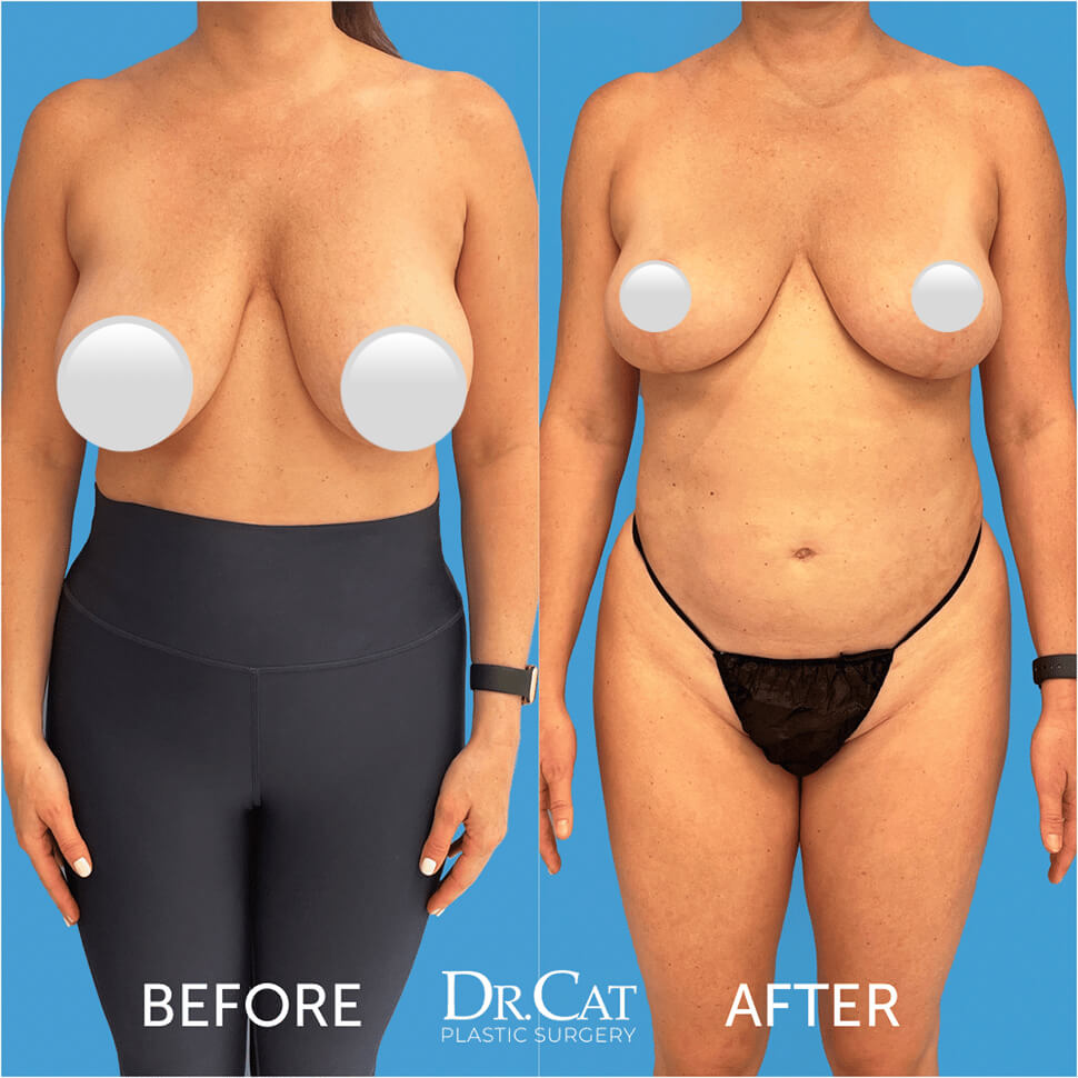 How This Surgeon Gets Beautifully Shaped Breast-Reduction Results