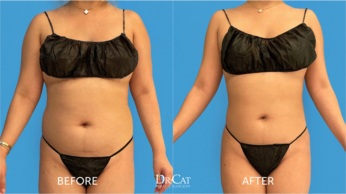 Liposuction healthy BMI results