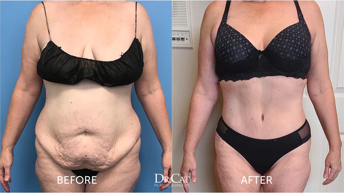 Plastic surgery BMI recommendation