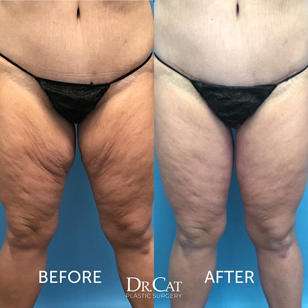 Body contouring after weight loss