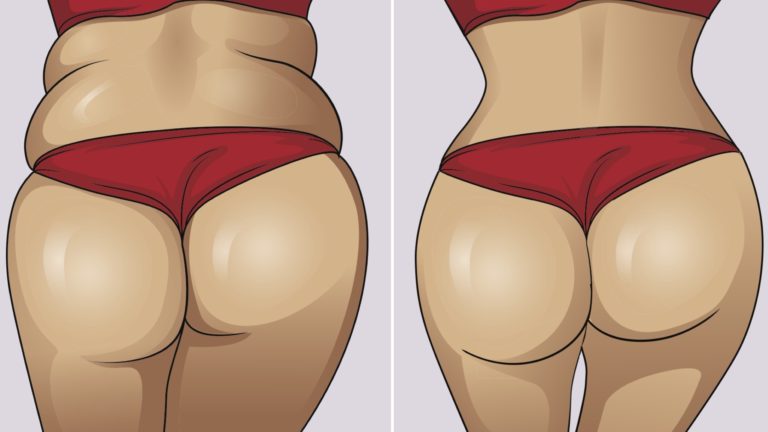 brazilian-butt-lift-things-to-know-before-surgery-banner