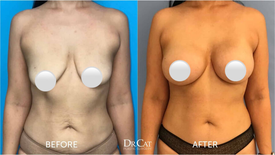 Submuscular breast implant placement showing implant positioned under the pectoralis muscle