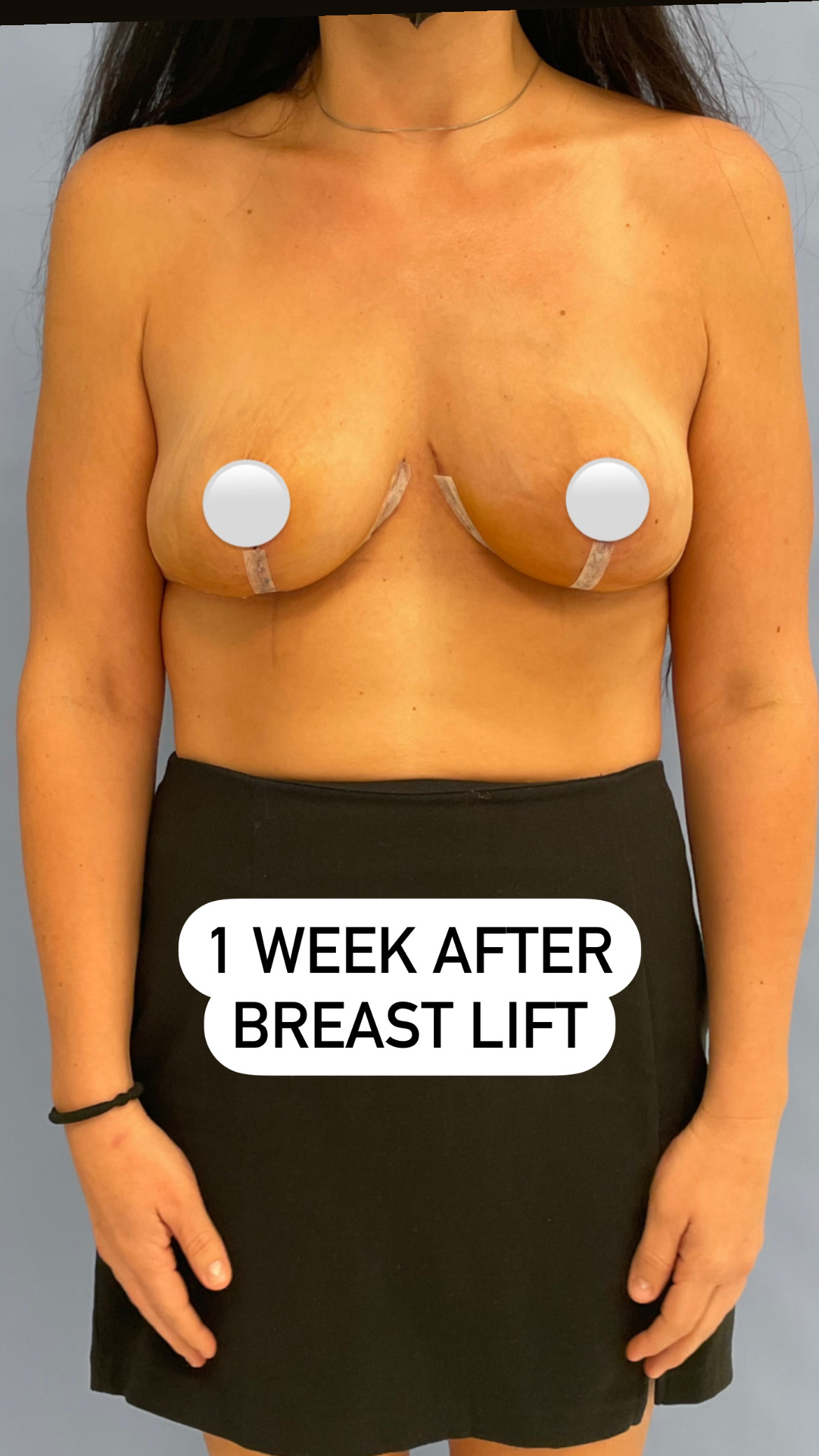 Breast lift post-op recovery at week 1 showing healing progress