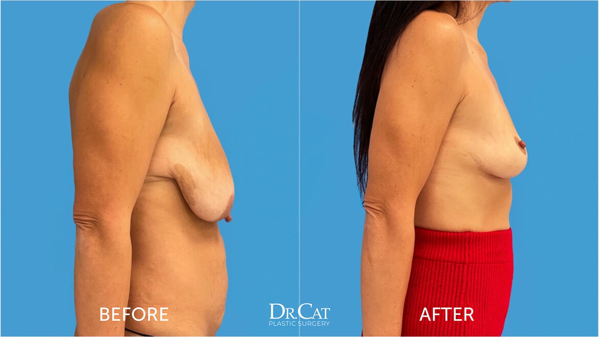 Breast lift specialist
