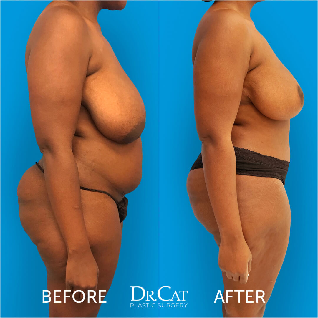 Breast reduction advantages