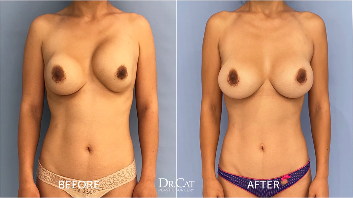 Breast revision results by Dr. Cat in Beverly Hills, the outcome a breast revision cost quote pays for