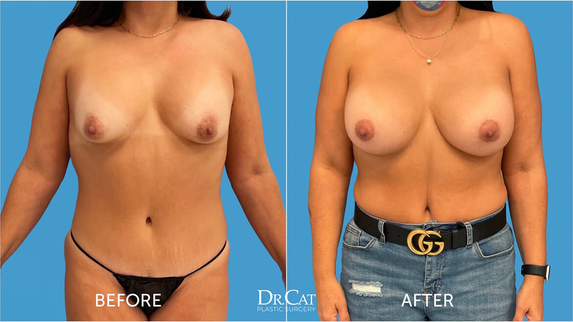 Breast revision surgery before and after by Dr. Cat for patients comparing breast revision cost near me in Beverly Hills