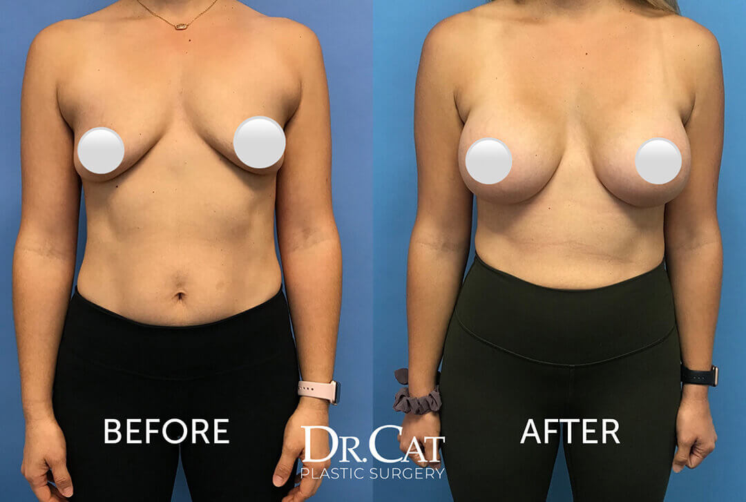 Breastfeeding with implants