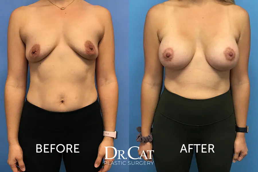 Before and after boob job 