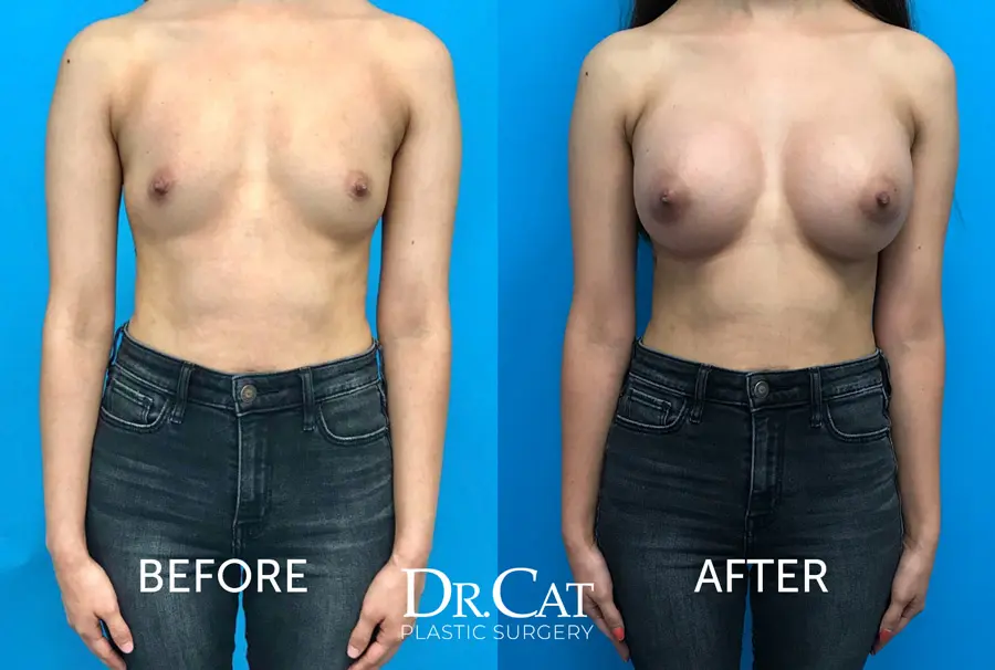 Breastfeeding with implants before and after photo 